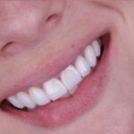 Transforme Seu Sorriso: Dr. Uelber Moraes e as Lentes em Resina