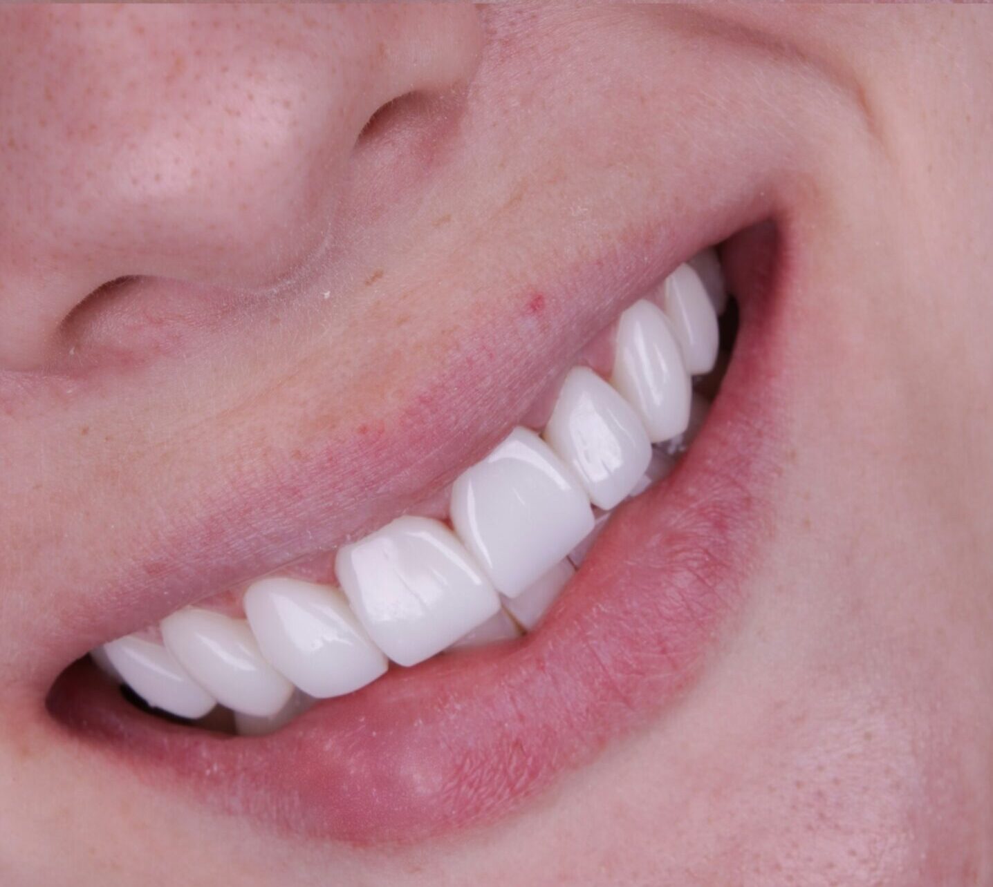 Transforme Seu Sorriso: Dr. Uelber Moraes e as Lentes em Resina
