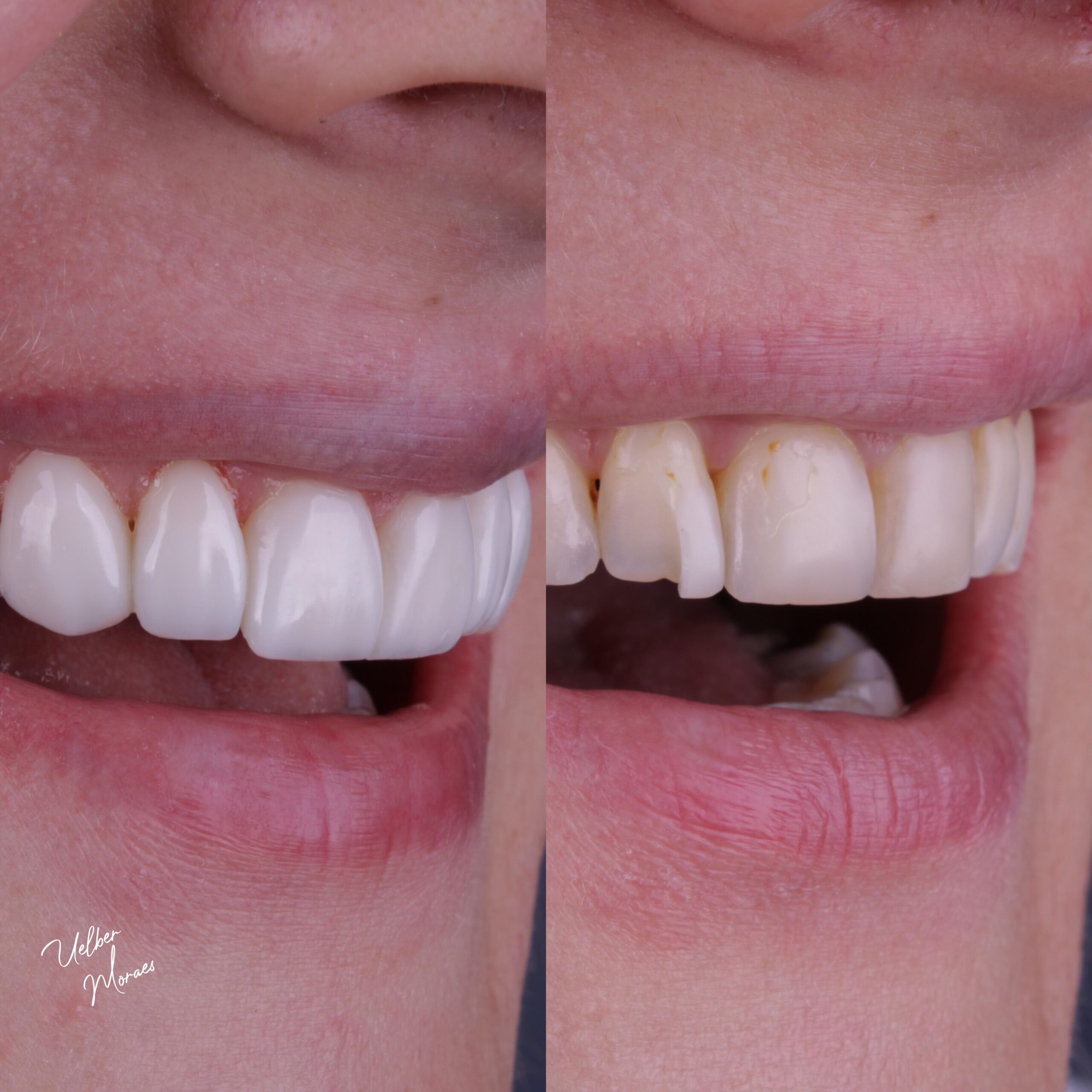 Facetas e Lentes de Resina: Um Terror Se Escolher Errado